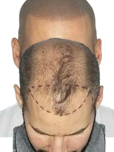 Mikropigmentacja skóry głowy | ArsMedica Konin