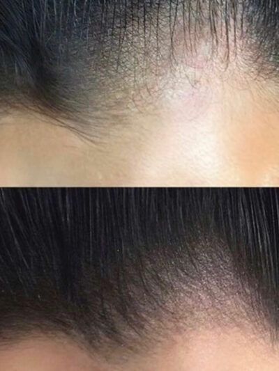 Mikropigmentacja skóry głowy | ArsMedica Konin